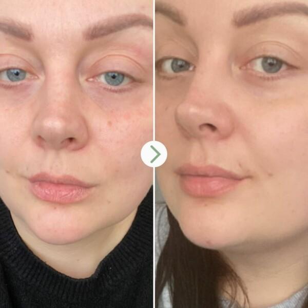 Pai_Rosehip_Biogenerate_10ml_Before_and_After.jpg